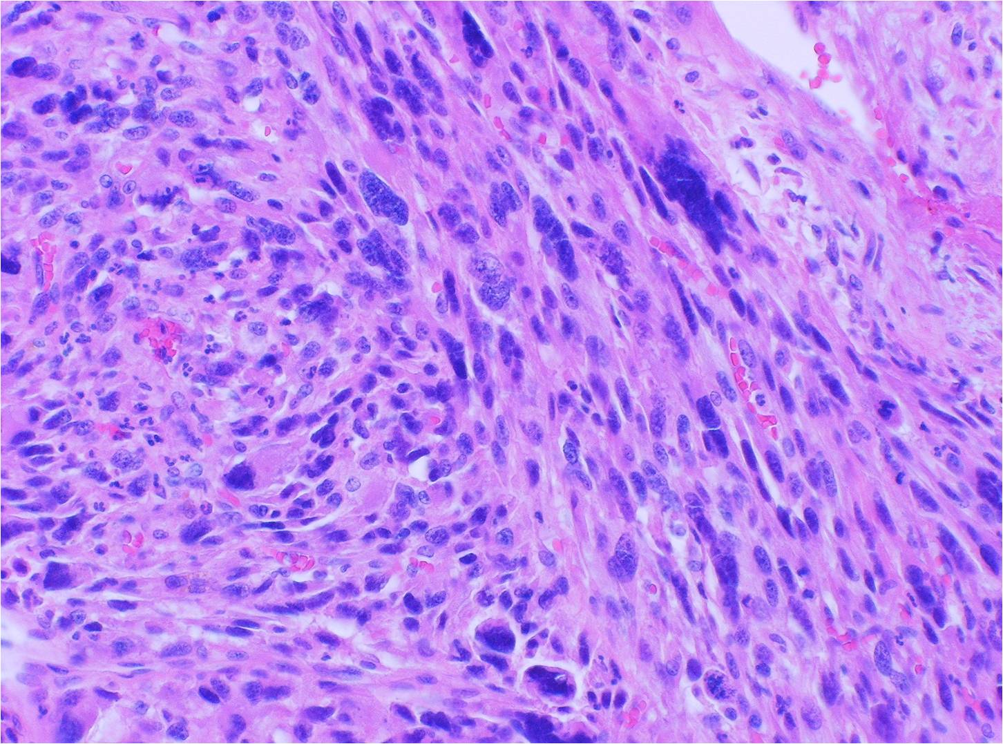 Neoplasm Myxoid Spindle Cell Neoplasm